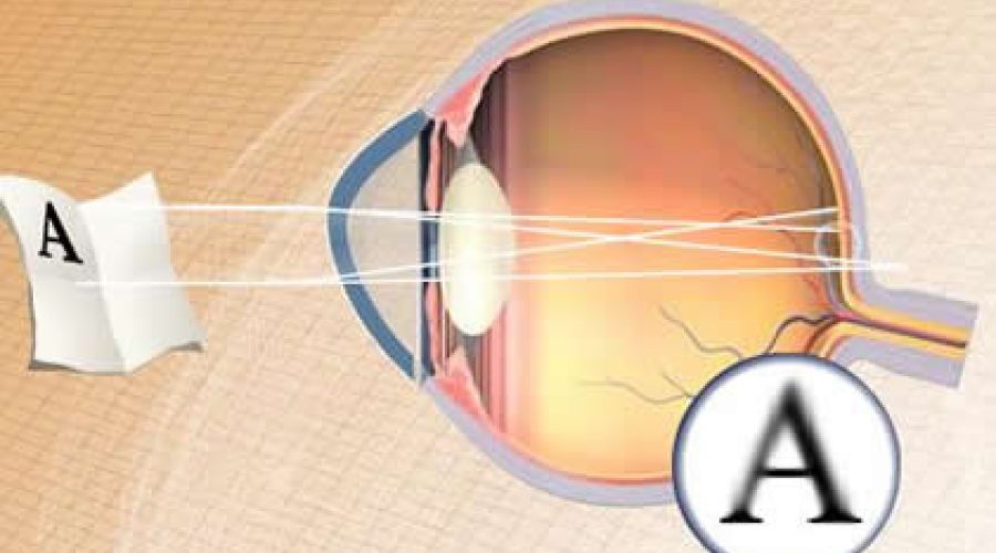 Astigmatismo