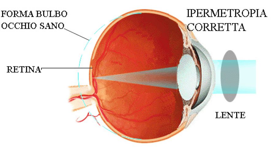 Ipermetropia