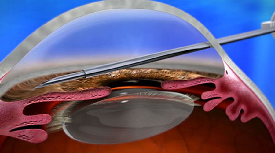 Xen Gel Stent